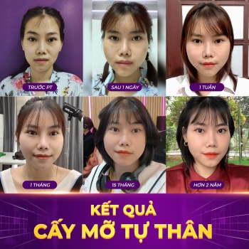 CẤY MỠ